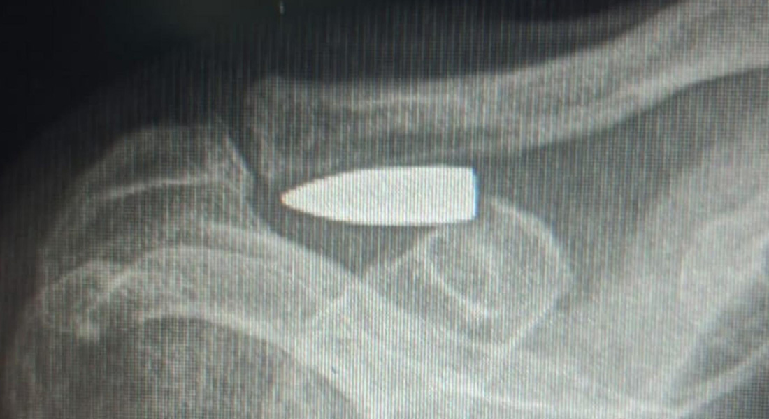 رصاصة طائشة من تشييع في الضاحية تُصيب مسنّ